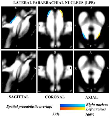 Probabilistic Template of the Lateral Parabrachial Nucleus, Medial Parabrachial Nucleus, Vestibular Nuclei Complex, and Medullary Viscero-Sensory-Motor Nuclei Complex in Living Humans From 7 Tesla MRI